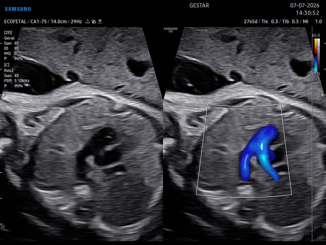 Ecocardiografia Fetal - imagem 6