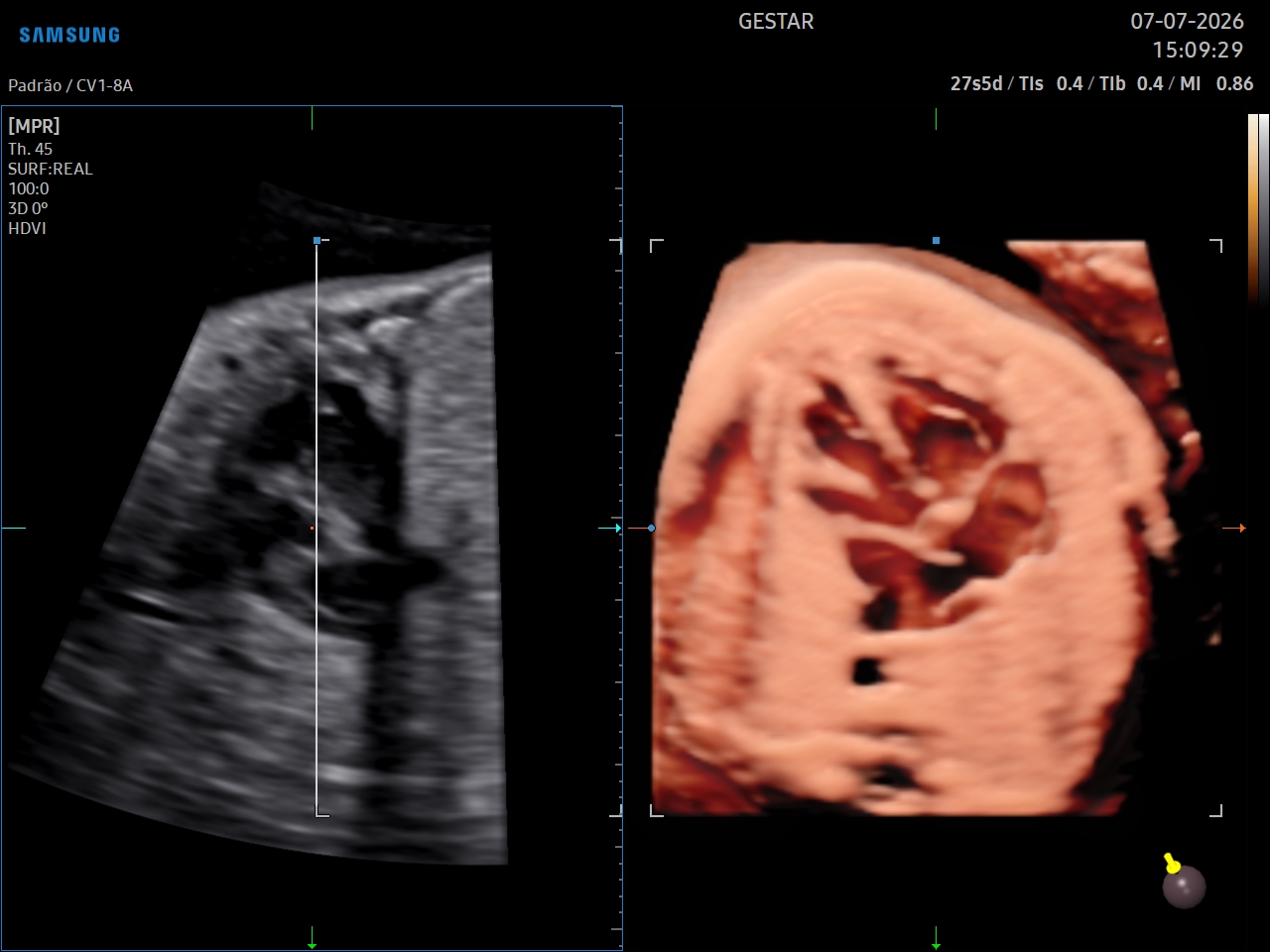 Ecocardiografia Fetal - imagem 2