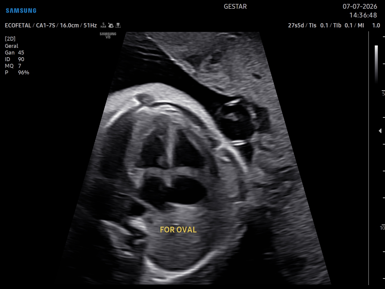 Ecocardiografia Fetal - imagem 5