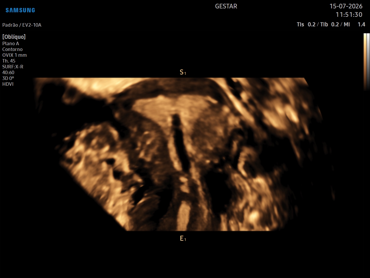 Ultrassom Transvaginal