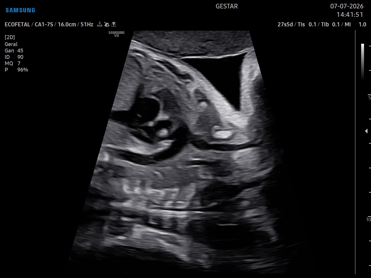 Ecocardiografia Fetal - imagem 3