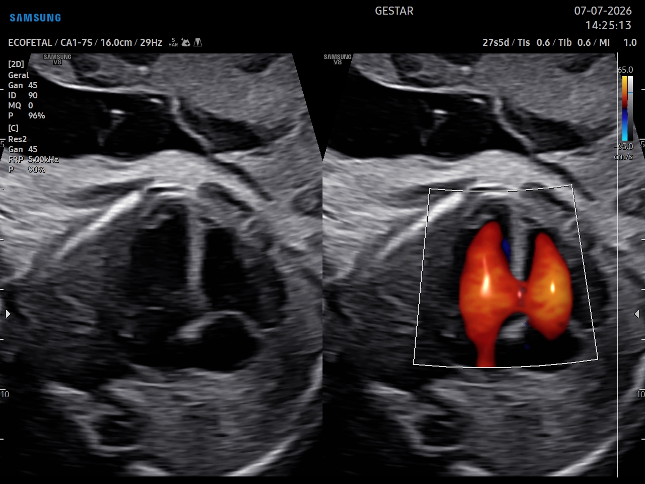 Ecocardiografia Fetal - imagem 4